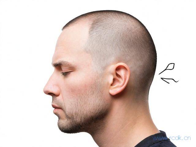 斑秃病怎么得的,斑秃是怎么来的