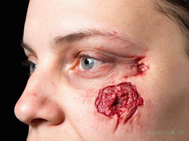 皮肤硬肿病是怎么回事,皮肤硬肿症是怎么形成的