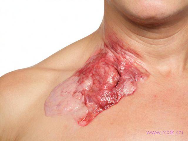 皮肤病湿疹怎么引起的,皮肤病湿疹是什么症状