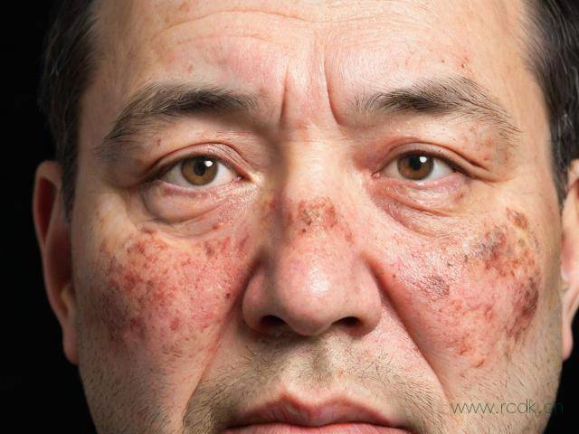 真菌性皮肤病是怎么引起的,真菌性皮肤病是啥